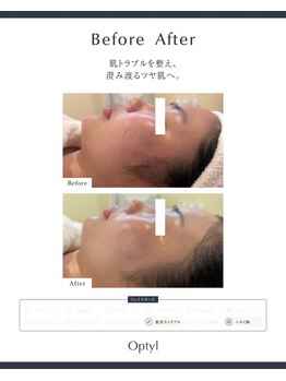 芯美 恵比寿店(shinbi)/オプティル*LDM水玉リフティング