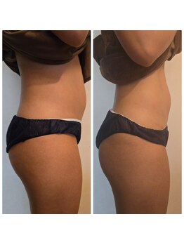 ロージーハピネス(Rosy happiness)/ラジオ派＋キャビテーション