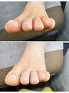 足指周りのケア
