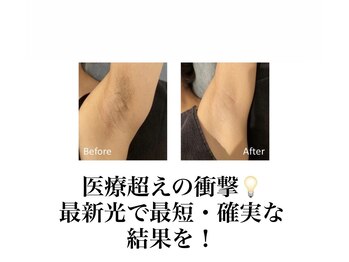 エースビューティー(Ace.Beauty)/肌も綺麗にする美肌脱毛