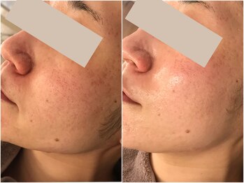 ミュレア 新宿本店(mulea)/【ララピール+サーマ】