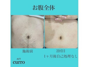 アクト クロ(ACT curro)/【お腹全体】脱毛施術例