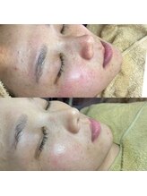 ミーミー 多治見店(MeMe.)/毛穴エクストラクション