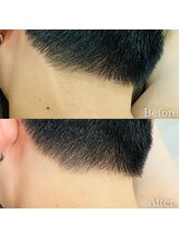 プリドー(PULIDO)/うなじ脱毛