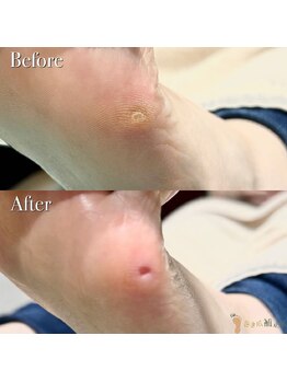 巻き爪補正店 大分店/【巻き爪/魚の目/副爪/タコ】