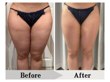 エミット(emit.)/太もももスッキリ