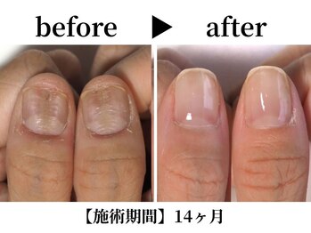 深爪プレミアムコース¥18,700