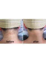 サロンアメリ 高松丸亀町店(Salon Ameri)/香川　高松　うなじ脱毛　アメリ