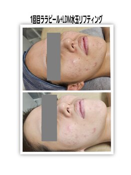 セレブリティ(Celebrity)/ララピール+LDM