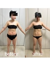 リノ ポノ(Lino Pono)/ビジリスとキャビテーション