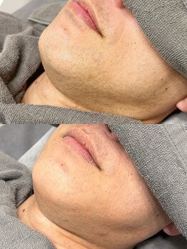 エピ リブレ(8epi.Libre)/ヒゲ　1回目から約2ヵ月後施術前