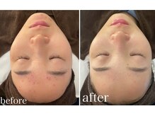 ベル 練馬(Belle)の雰囲気（【お得な回数券あり◎】ハーブピーリング/プラズマで肌質改善）