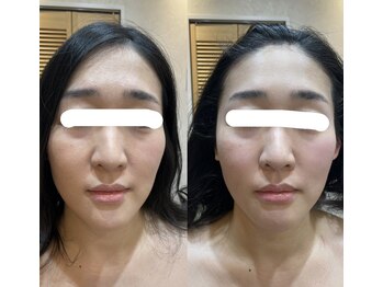 トゥーリ 春日店(tuuli)/ビフォーアフター