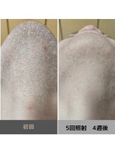 キムラケ 和光別邸(木村家 KIMURAKE)/メンズ脱毛ヒゲビフォーアフター