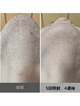 キムラケ 和光別邸(木村家 KIMURAKE)/メンズ脱毛ヒゲビフォーアフター