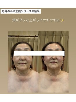 トトノエル(TOTONOEL)/小顔筋膜リリース