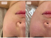 セレーノ 白金台(seReno)/小顔FA Before→after