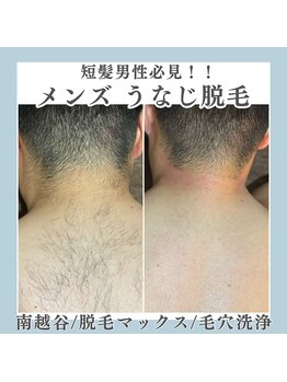 脱毛マックス 南越谷店(MAX)/【うなじ】Before★After