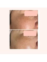 モンクール(mon coeur)/ララピール×フォト