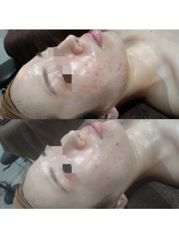 ボーソリューション(Beau-Solution)/【20代　赤みニキビケア】