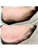 ブルーモ(Bloomo)/Before After［おでこ］