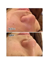 パルティール 銀座店 partir/１回の効果！【銀座】