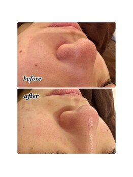 パルティール 銀座店 partir/１回の効果！【銀座】