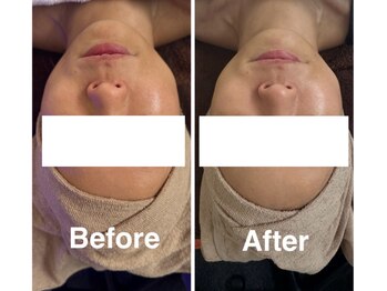 ウミン(UMIN)/法令線や目元たるみが気になる方