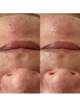 イルガドット 897(ilga.897)/毛穴 1回での変化