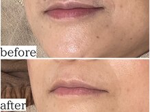 アンドナップ(nap)の雰囲気（産毛や余分な角質・角栓を除去し、美容成分導入し肌質改善！）