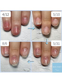 エオル(eol.)の写真/【縦長の美爪へ！】《噛み癖・むしり癖・貝爪・まむし爪・深爪》爪を育てましょう☆パラジェル・フィルイン