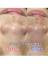 ルミエール(LUMIE’RE)/フェイシャルWax脱毛
