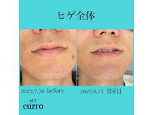 アクト クロ(ACT curro)/【ヒゲ全体】脱毛施術例