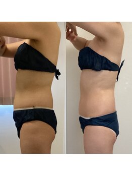 サンテ エ ボーテ 福岡博多店(Sante et Beaute)/痩身/くびれを作りたい♪