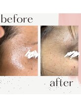 ミルル(milulu)/毛穴の引き締め