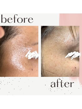 ミルル(milulu)/毛穴の引き締め