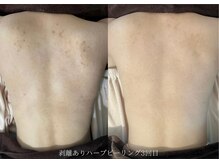 大人気のボディハーブピーリング
