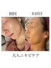 【肌トラブル美肌改善！】繰り返す大人ニキビ改善コース