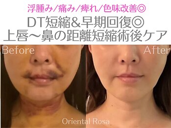 オリエンタルローザ 表参道(Oriental Rosa)/人中短縮インディバ術後ケア