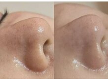 ローハ(ROHA)/名古屋市港区フェイシャルサロン