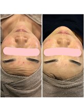 モンド 駒込店(monde)/ハーブピーリング