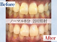 LBSホワイトニング 吉祥寺店/ホワイトニングビフォーアフター