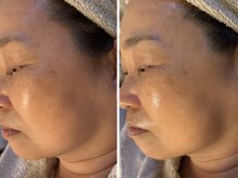 ピュアリー(purly)/【レモンボトル】Before After