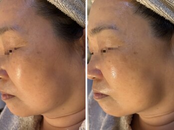 ピュアリー(purly)/【レモンボトル】Before After