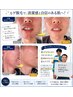 メンズ全身脱毛　体験＆カウンセリング