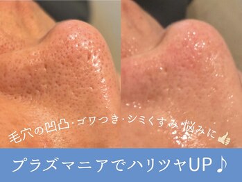 シュリー(Sriii)の写真/毛穴開き/凹凸/黒ずみ/シミくすみの悩みを解決！高密度プラズマで古い角質を除去＆美容液導入で毛穴レス♪