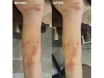 エッセンスビー 六本木/二の腕