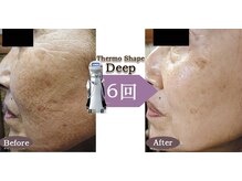 Nビューティー/最新RFサーモシェイプオーパス
