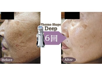 Nビューティー/最新RFサーモシェイプオーパス