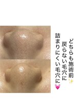 ラウレア(Laule’a)/毛穴洗浄